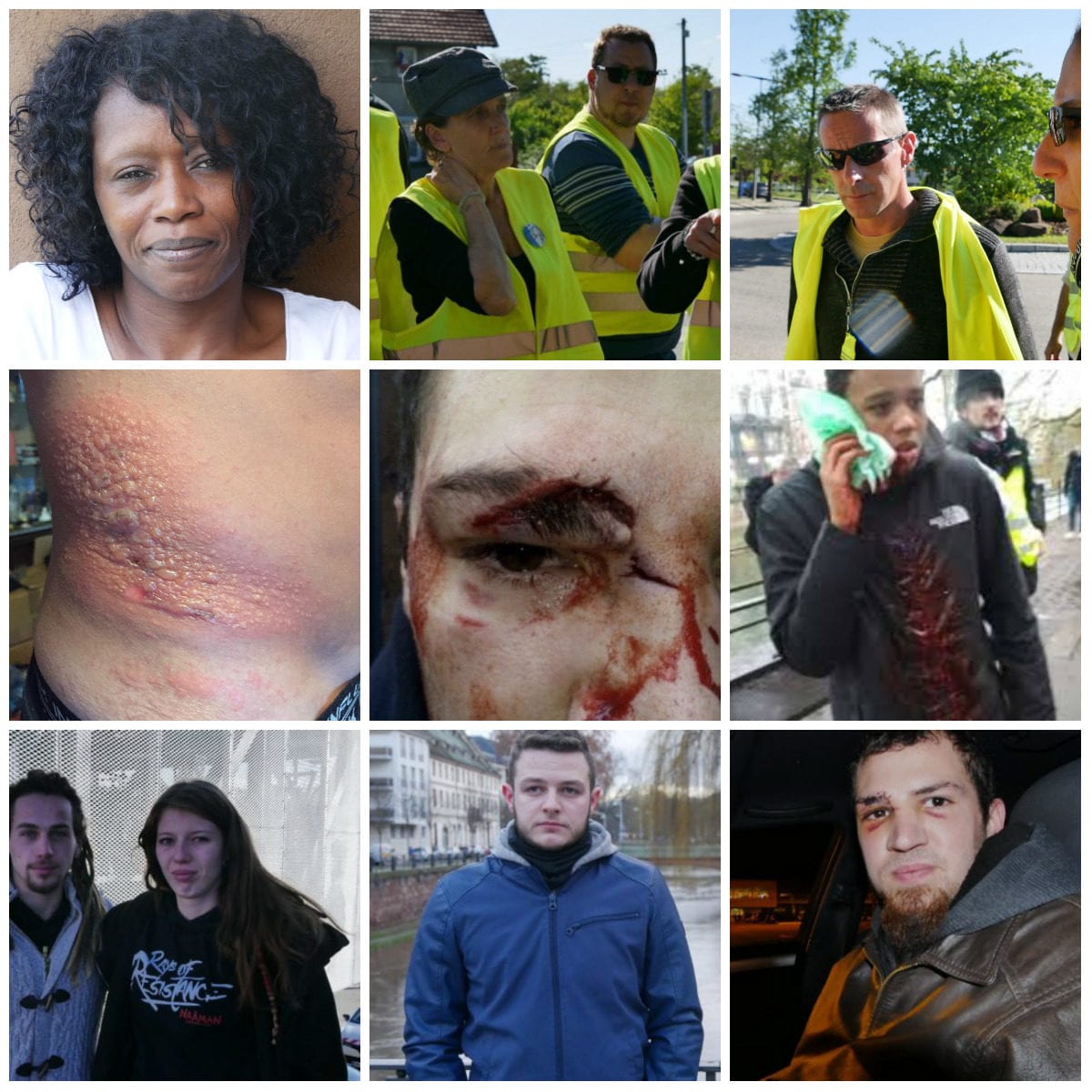 Six mois après les blessures : « Les violences policières ont ruiné ma vie »